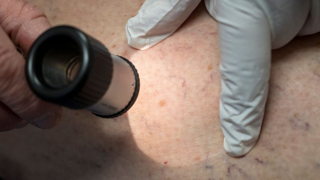 Krankheiten: Hautkrebs in Hessen ungleich verteilt