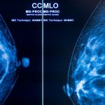 Programm zur Früherkennung: Mammografie-Screening senkt Brustkrebs-Sterblichkeit