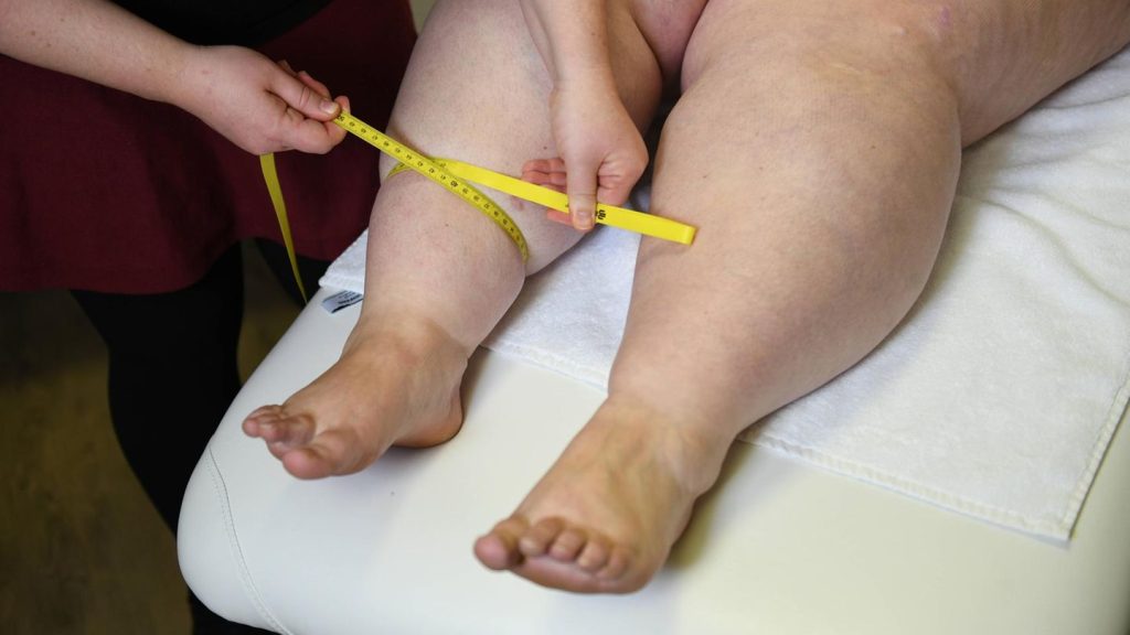 Vor allem Frauen betroffen: Fettabsaugen bei Lipödem bezahlt künftig die Krankenkasse