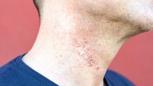 Hautreizungen: So behandeln Sie Rasurbrand richtig – und beugen neuem vor