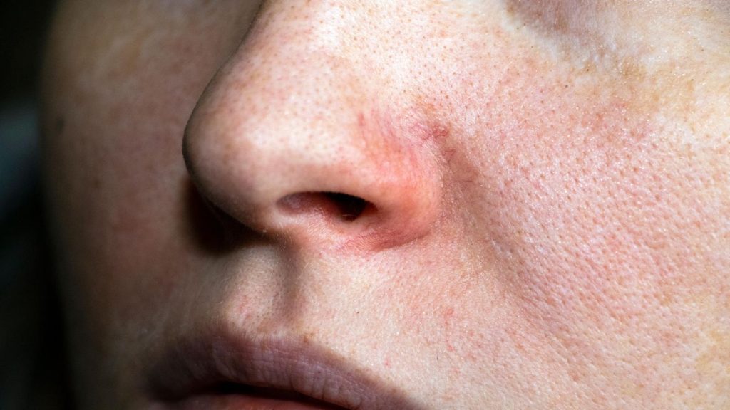 Rote Äderchen im Gesicht: Rosacea-Creme gegen Hautrötungen: Diese Produkte sollen die Symptome lindern