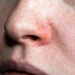Rote Äderchen im Gesicht: Rosacea-Creme gegen Hautrötungen: Diese Produkte sollen die Symptome lindern