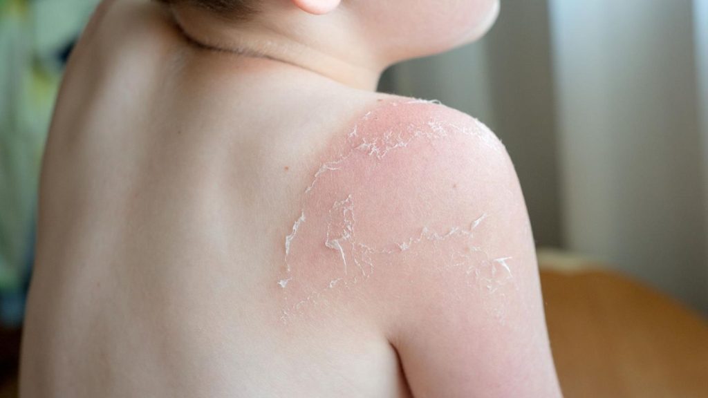 Auf Sylt: Sonnenbrand auf Klassenfahrt: Schülerin im Krankenhaus, Anzeige gegen Lehrer