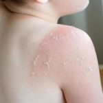 Auf Sylt: Sonnenbrand auf Klassenfahrt: Schülerin im Krankenhaus, Anzeige gegen Lehrer