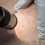 Gesundheit: Krankenkasse: Deutlich mehr Hautkrebsfälle in Niedersachsen