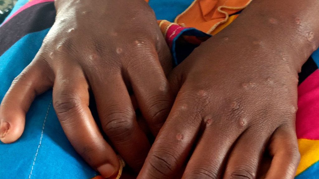 Krankheiten: Internationale Notlage wegen Mpox aufgehoben