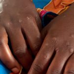 Krankheiten: Internationale Notlage wegen Mpox aufgehoben